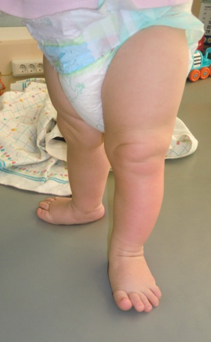Ножки в 6 месяцев. Гипертонус ног у ребенка. Гипертонус стопы у детей.